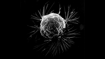 microscopy scan of breast cancer cell